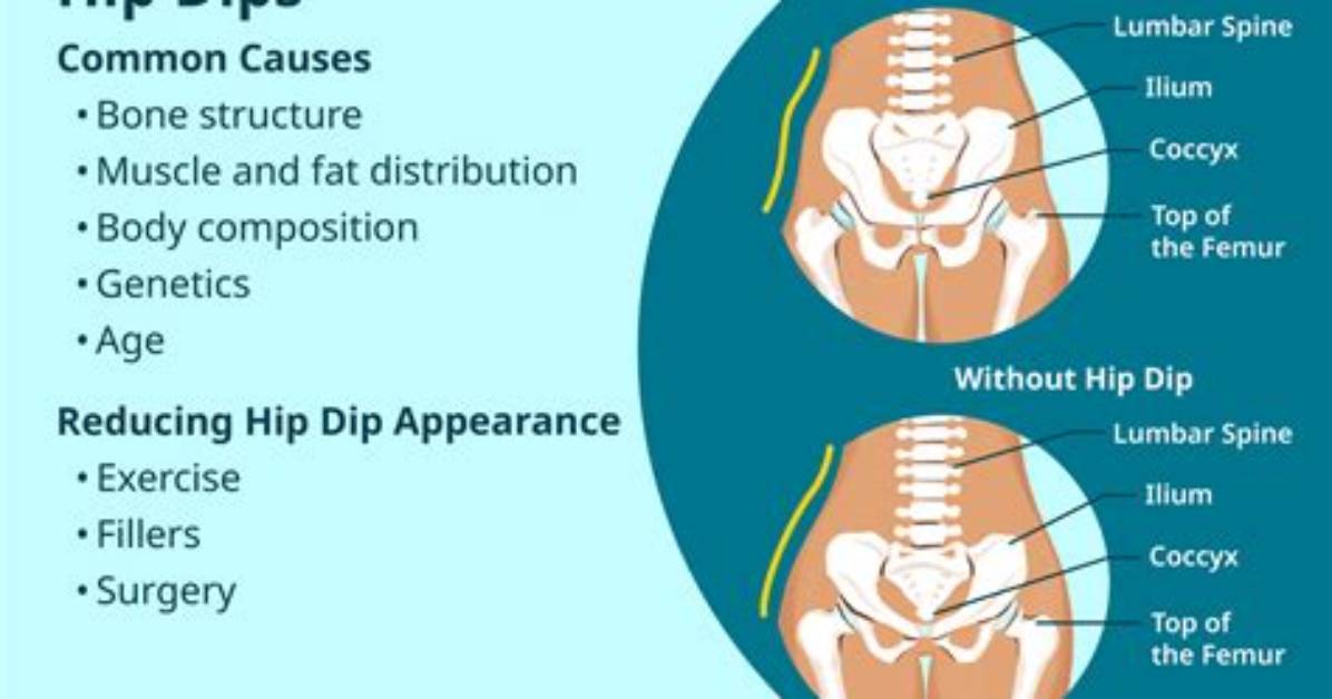 How Many Times Can a Hip Be Replaced?