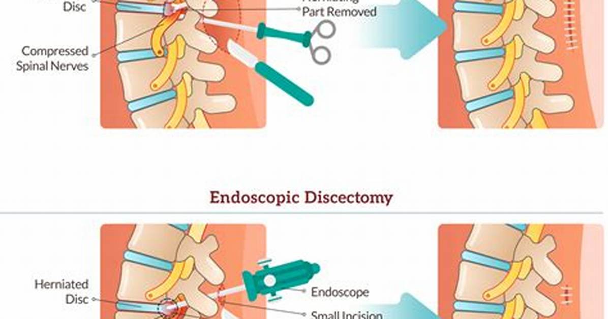How Much Can I Lift After Discectomy?