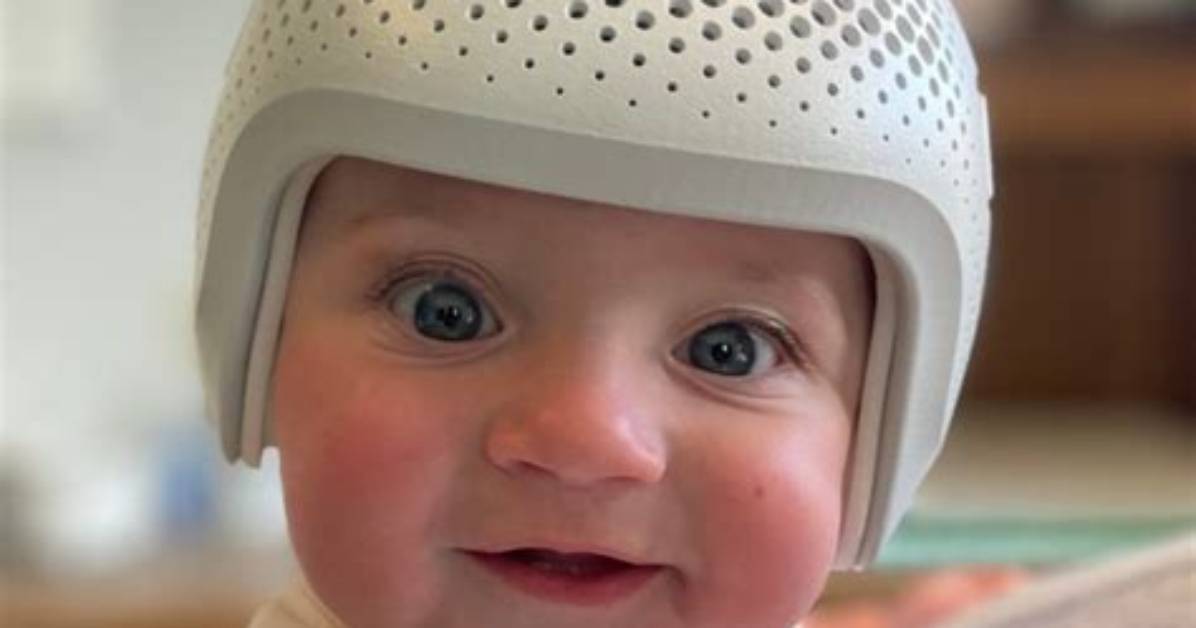 How Much Is a Baby Helmet?