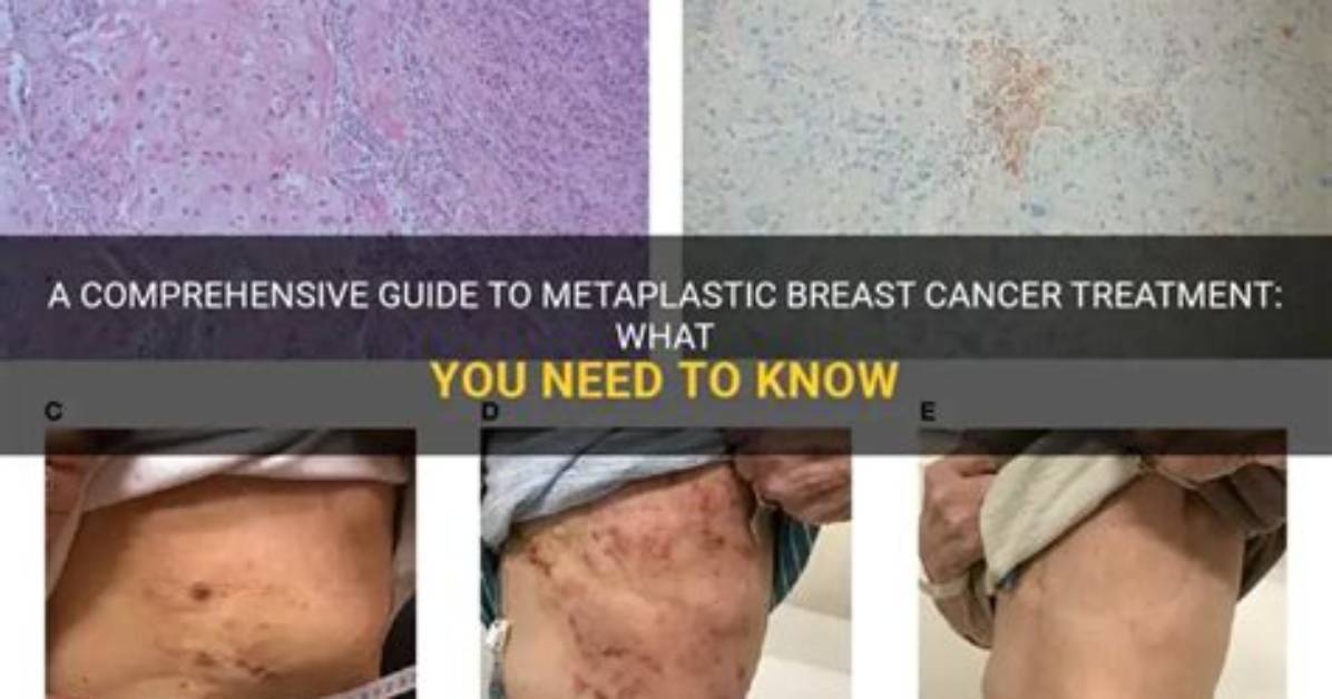 How Rare Is Metaplastic Breast Cancer?