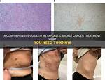 How Rare Is Metaplastic Breast Cancer?
