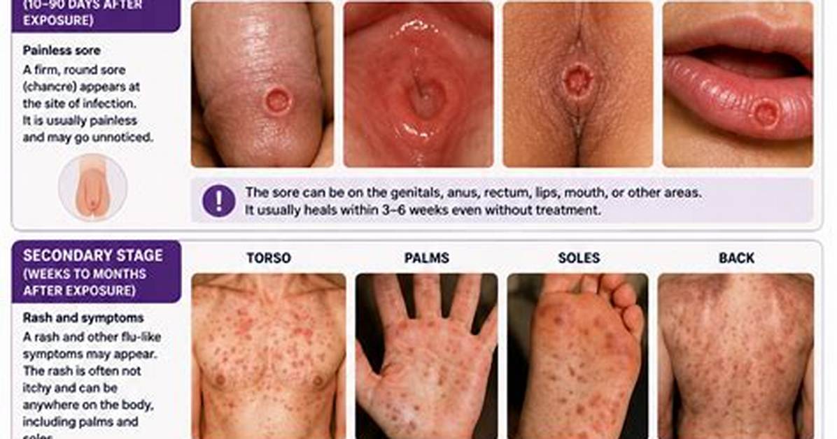 How Soon Do Syphilis Symptoms Show?