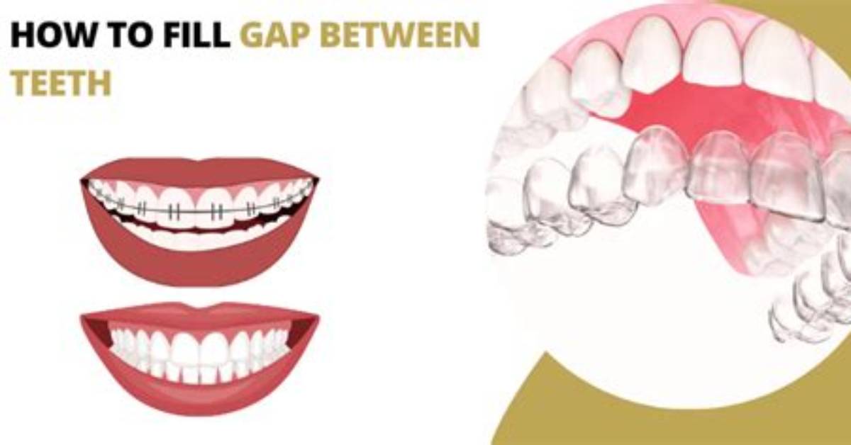 How to Fill Gaps