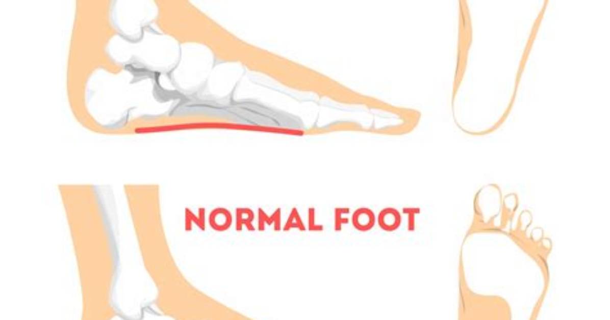 How to Get Diagnosed with Flat Feet?