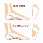 How to Get Diagnosed with Flat Feet?