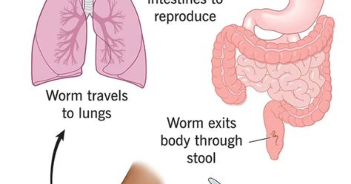 How to Kill Hookworms In