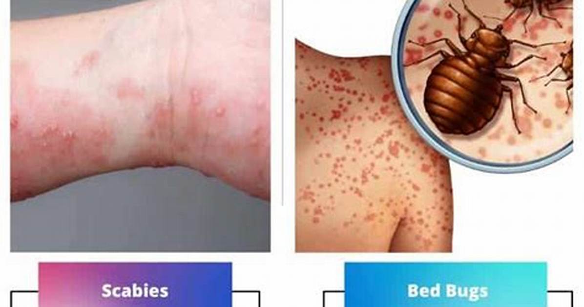 How to Kill Lice Scabies and Bed Mites in The