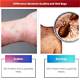 How to Kill Lice, Scabies and Bed Mites in the Home