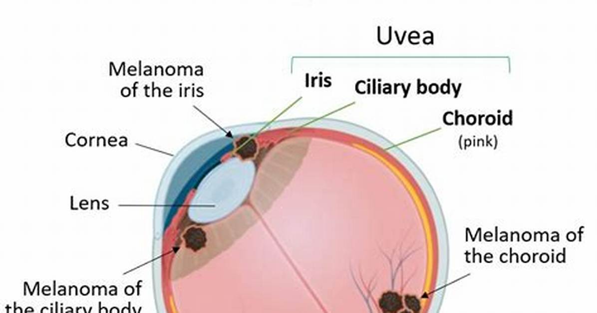How to Prevent Uveal Melanoma?