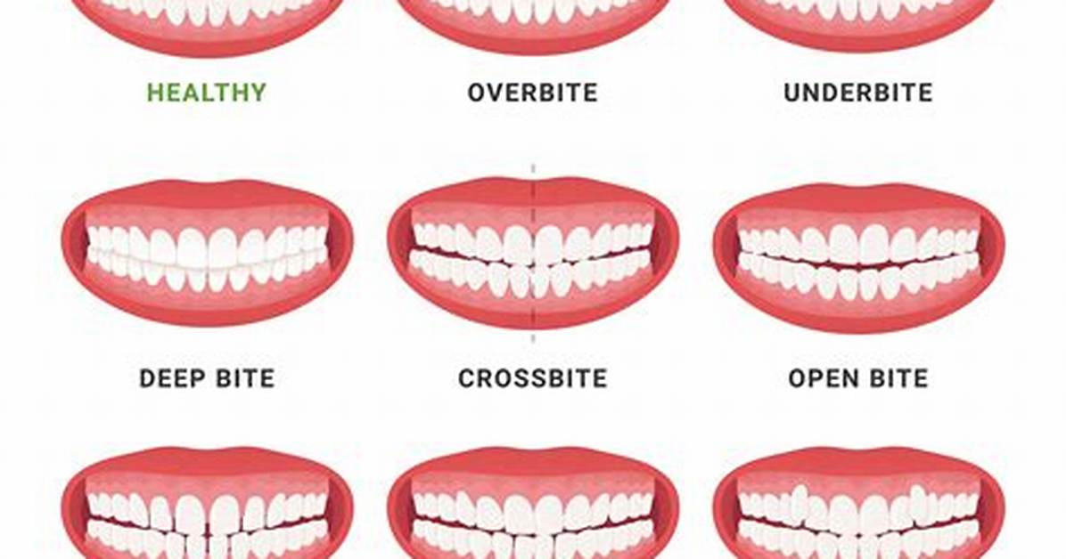 How Wide Should the Mouth Be?