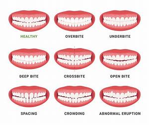 How Wide Should the Mouth Be?