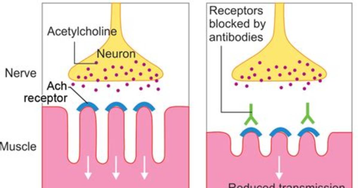 In Myasthenia Gravis Acetylcholine?