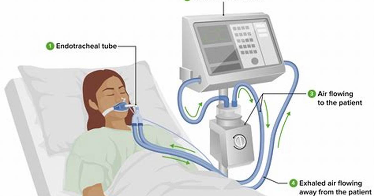 Is Being on a Ventilator the Same as Being on Life Support?