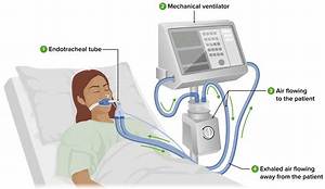 Is Being on a Ventilator the Same as Being on Life Support?