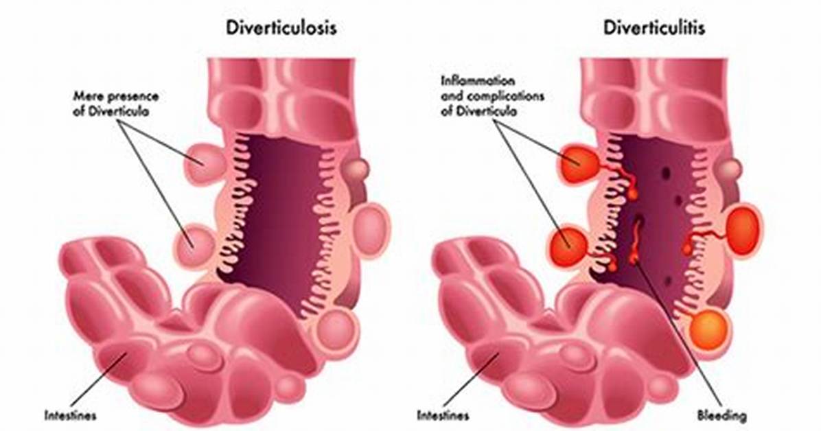 Is Diverticular Disease Curable?