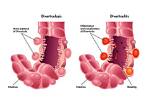 Is Diverticular Disease Curable?