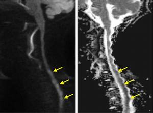 Is Fibrocartilaginous Embolism Painful?