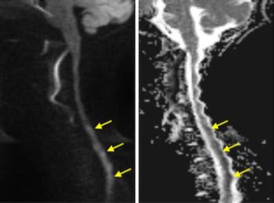 Is Fibrocartilaginous Embolism Painful?