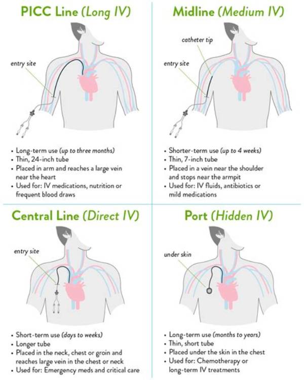 Is Getting a Picc Line Painful?