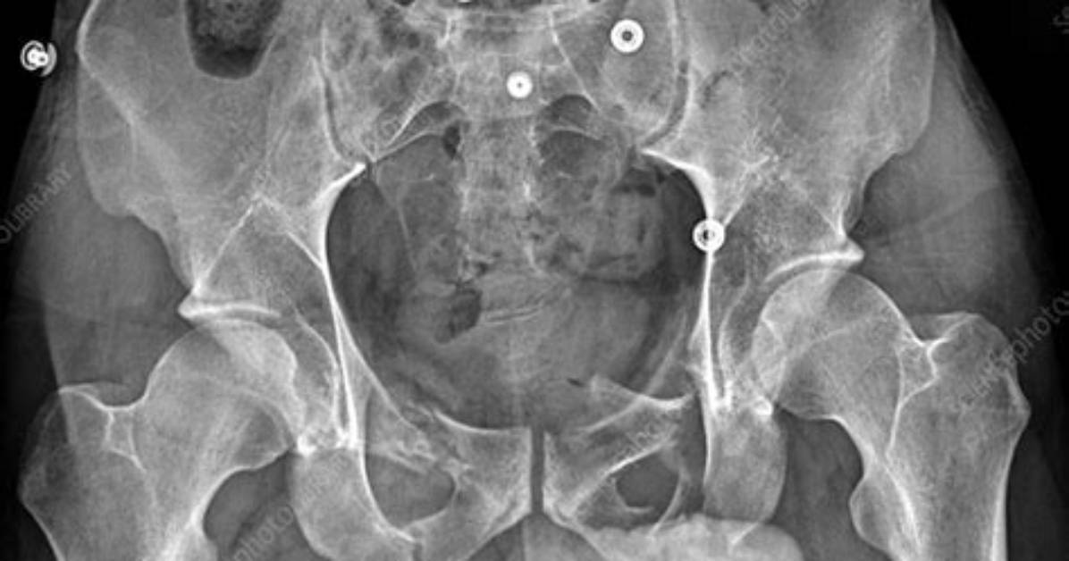 Is Heat Good for Fractured Pelvis?