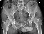Is Heat Good for Fractured Pelvis?