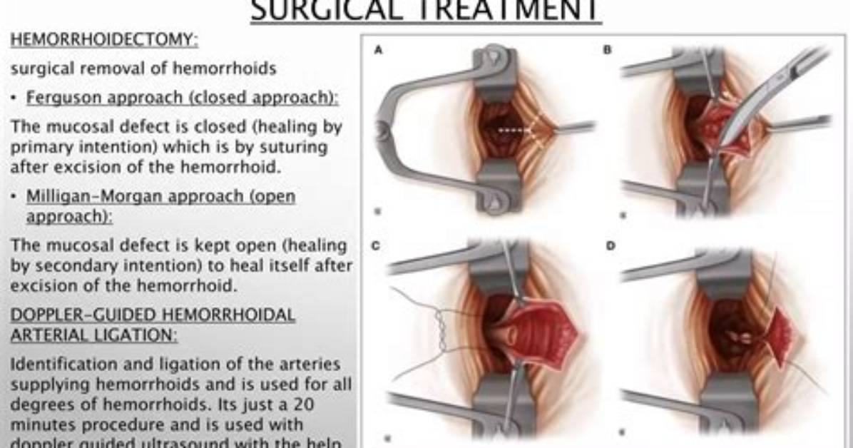 Is Hemorrhoid Removal Painful?