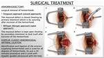 Is Hemorrhoid Removal Painful?