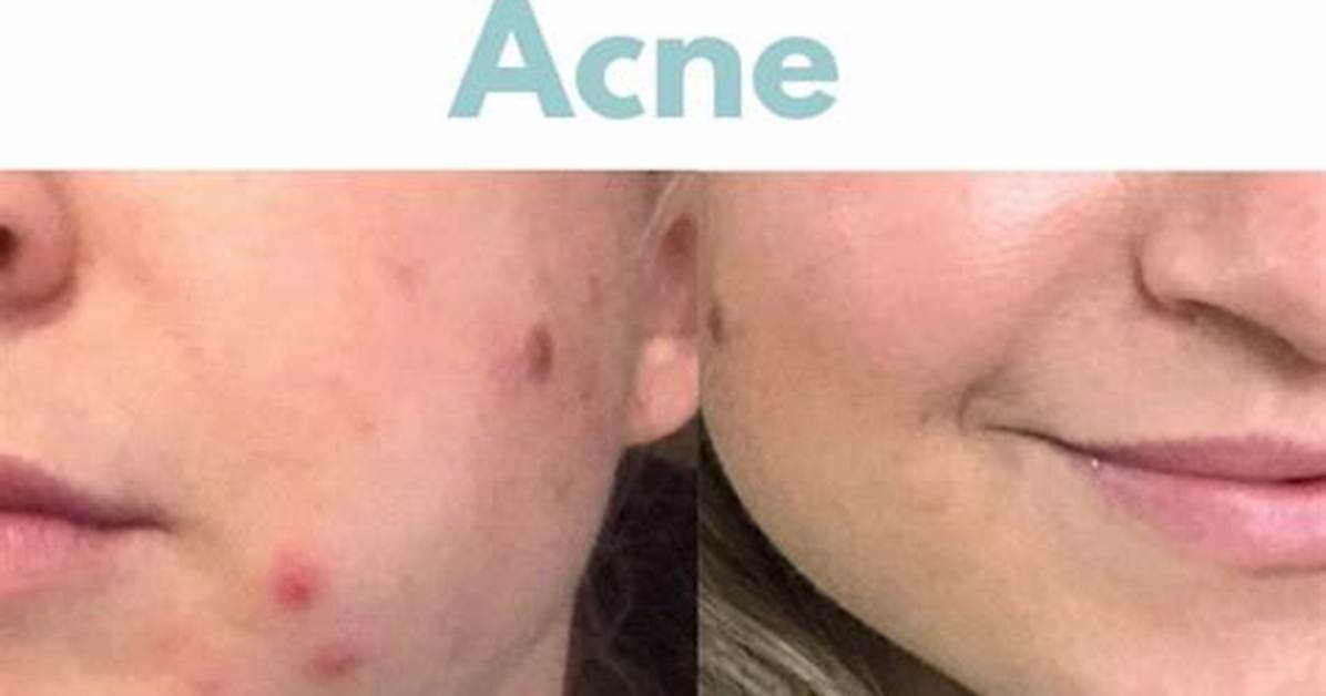 Is Ice Good for Acne?