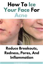 Is Ice Good for Acne?