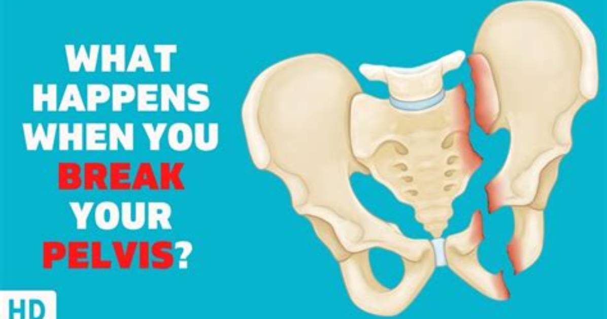 Is It Easy to Break Your Pelvic Bone?