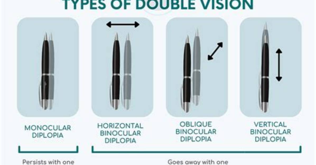 Is It Normal to See Double After Prk?