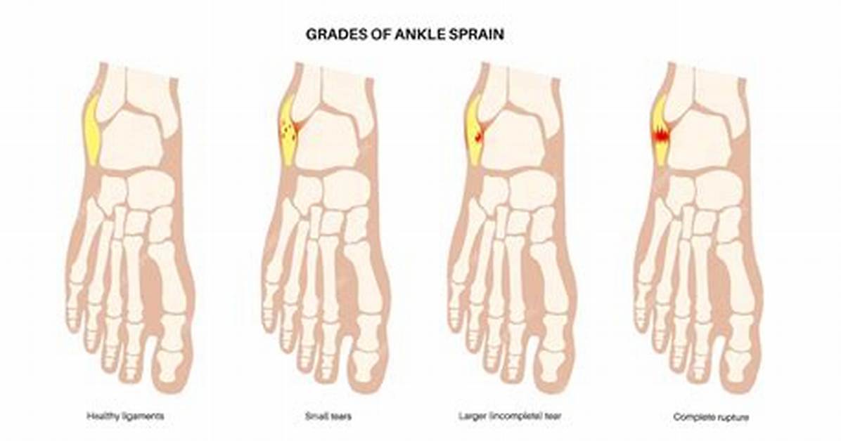Is It Ok to Stretch a Sprained Ankle?