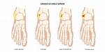 Is It Ok to Stretch a Sprained Ankle?