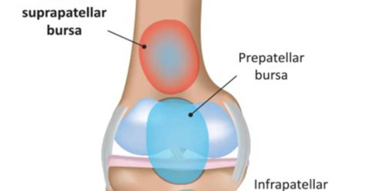Is Knee Bursitis Serious?