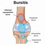 Is Knee Bursitis Serious?