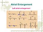 Is Left Atrial Enlargement Reversible?