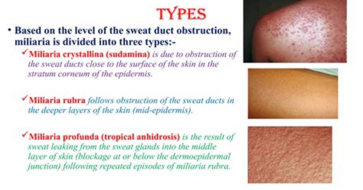 Is Miliaria Crystallina Contagious?
