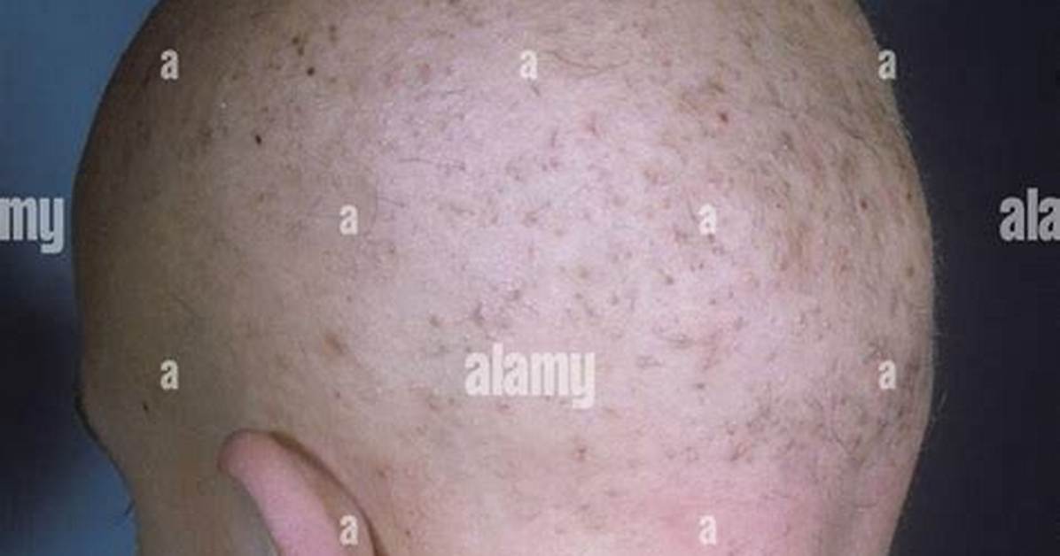 Is Monilethrix a Genetic Disease?