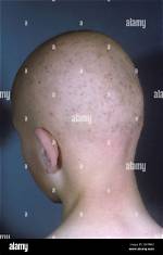 Is Monilethrix a Genetic Disease?