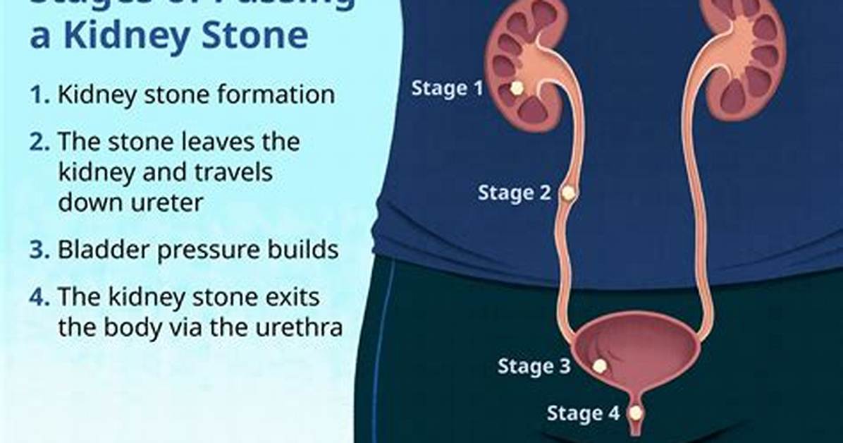 Is Passing a Kidney Stone Comparable to Childbirth?