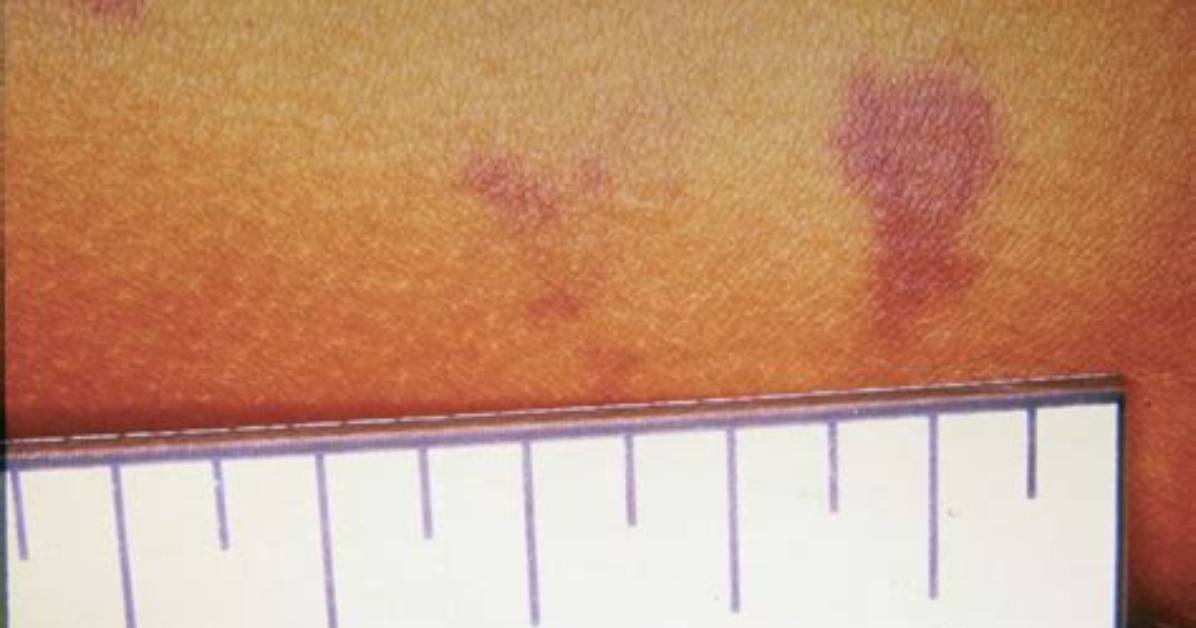 Is Petechiae Always Leukemia?