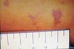 Is Petechiae Always Leukemia?