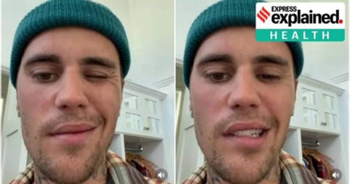 Is Ramsay Hunt Syndrome Permanent? Justin Bieber Paralyzed Face Illness Explained