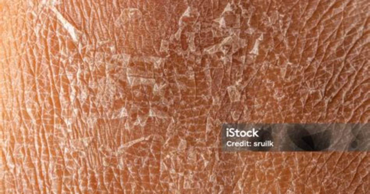 Is Skin Peeling Good for Eczema?