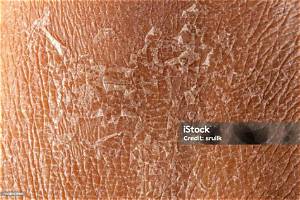 Is Skin Peeling Good for Eczema?