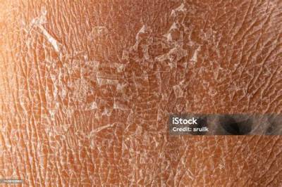 Is Skin Peeling Good for Eczema?