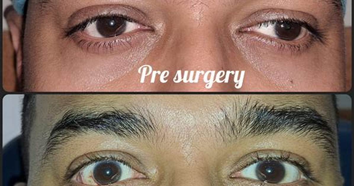 Is Squint Surgery Safe?