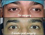 Is Squint Surgery Safe?