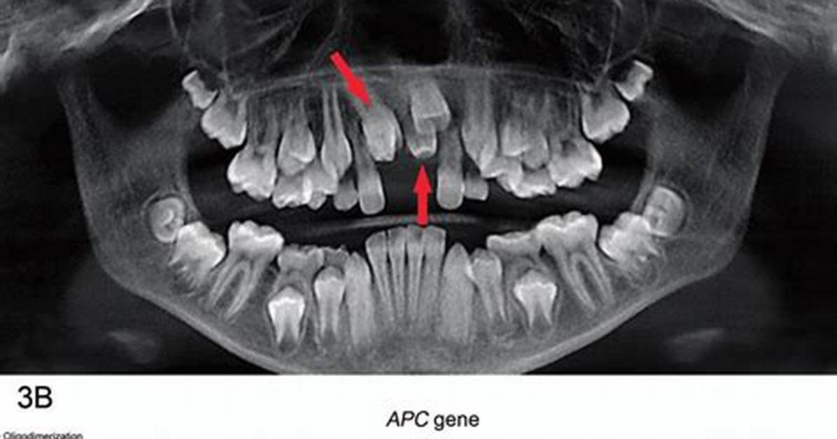 Is Supernumerary Teeth Genetic?