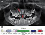 Is Supernumerary Teeth Genetic?